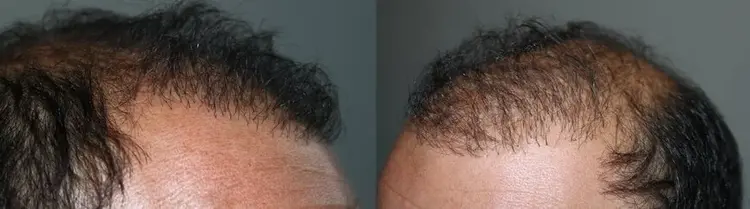 Eine gescheiterte Haartransplantation: falsche Winkel, mehrfache Haargrafts im Haaransatz und ein dünnes Erscheinungsbild.