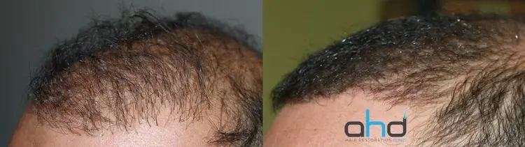 Haartransplantation Korrektur