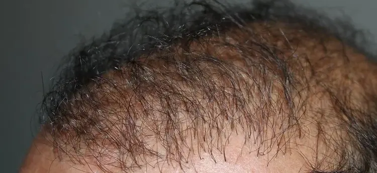 Eine schiefgelaufene Haartransplantation