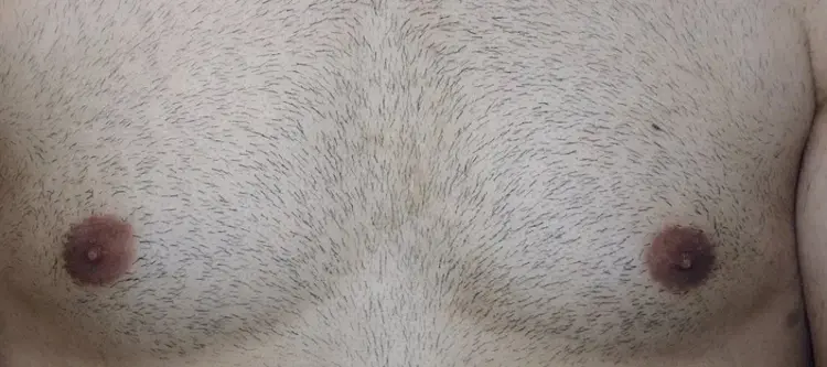 Körperhaartransplantation auf den Kopf