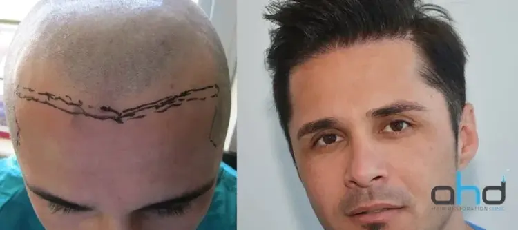 Trapianto di capelli naturale