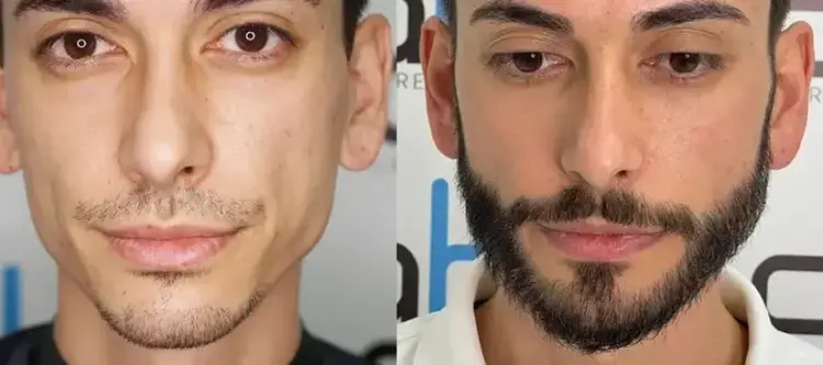 Trasplante de barba en Turquía