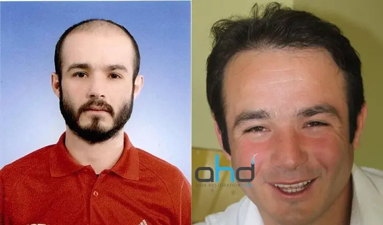 Un nacimiento del cabello natural y el resultado perfecto de un trasplante capilar.

