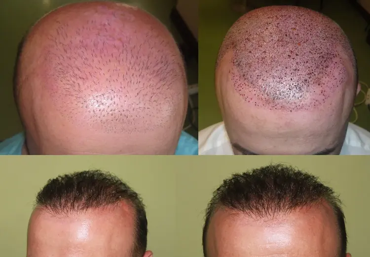 How to fix a bad look in a hair transplant? The answer is in the picture