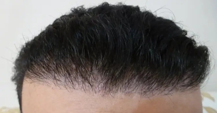 A terrible and bad hairline that forms after a hair transplant