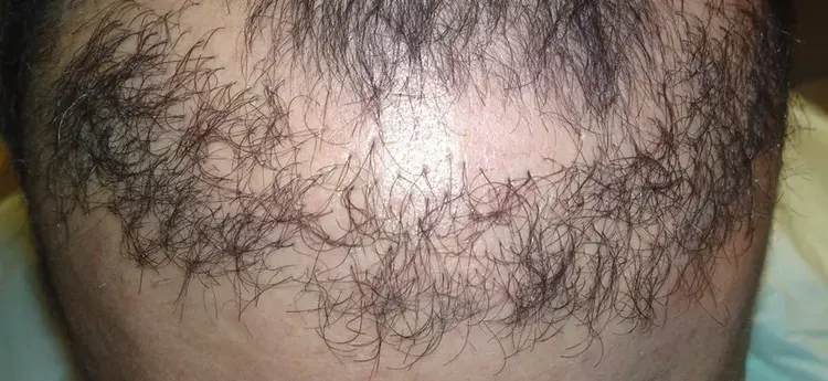 başarısızlıkla sonuçlanan saç ekimi örneği