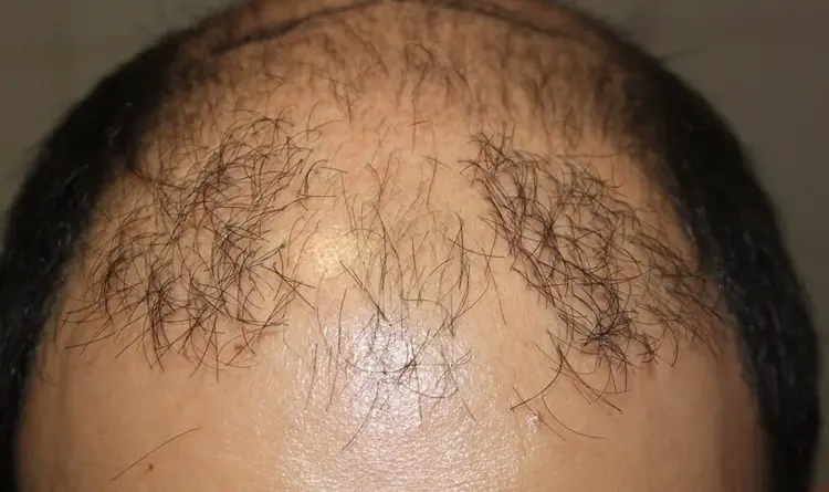 The poor result of a botched hair transplant.