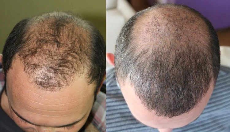 a failed hair transplant surgery and its corrected image