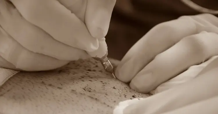 greffe cheveux poils corps