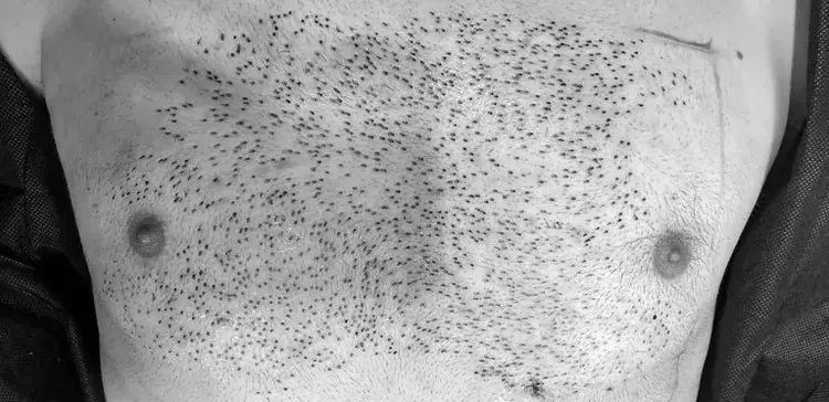 greffe de cheveux thoracique