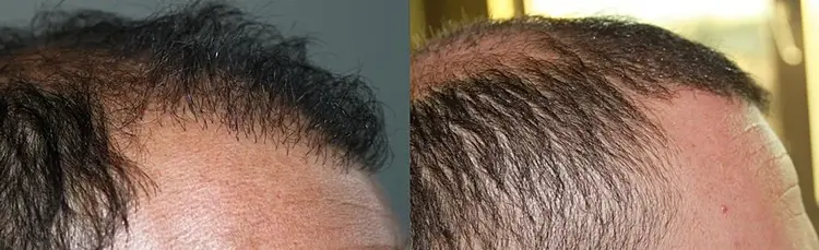 How to repair a bad hairline