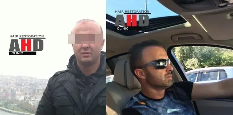 hatalı saç ekiminden sonraki düzeltmeyle oluşan doğal görüntü