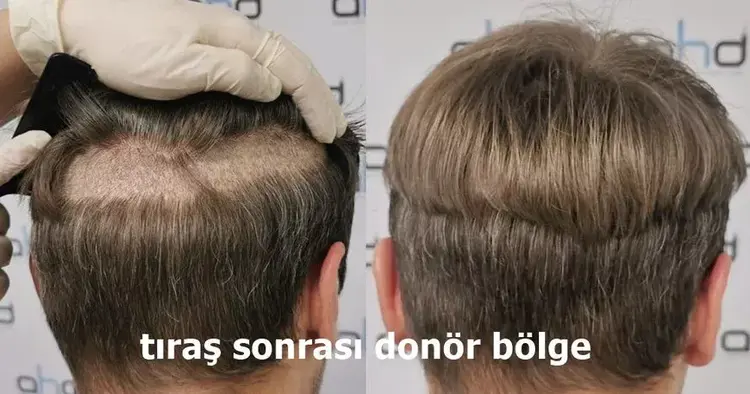 saç kesmeden ekimi ve greft alımı sonrası görüntü