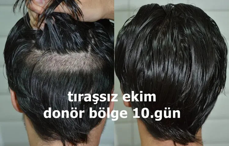 tıraşsız saç ekiminde donör bölgenin 10 gün sonraki görünümü