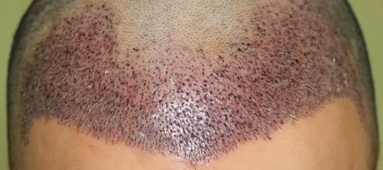 transplante de cabello