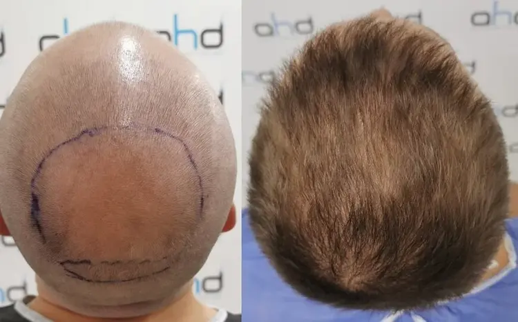 transplante capilar coroa