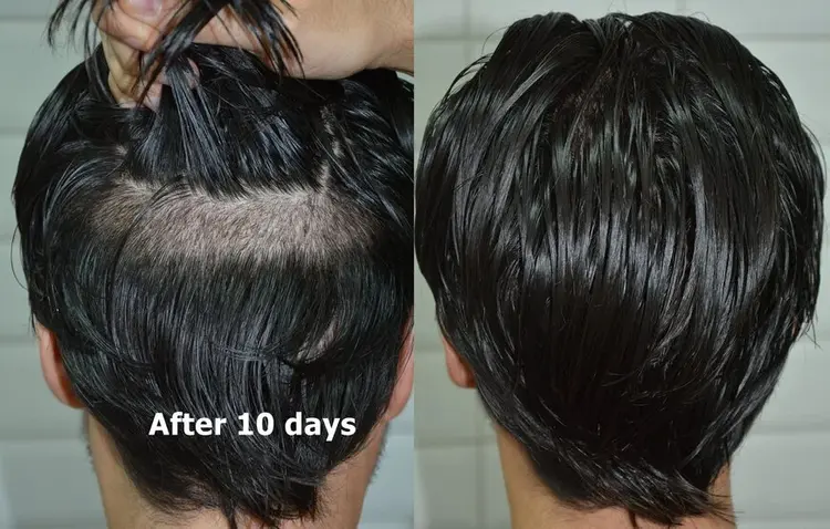 Trapianto di capelli senza rasatura e 10 giorni dopo