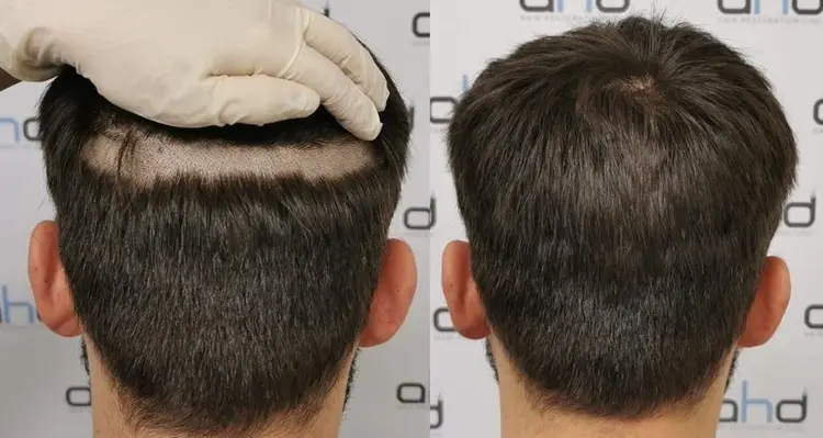 trapianto di capelli senza rasatura