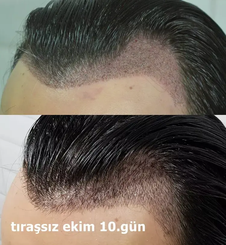 traşsız yöntemle ekim yapılacak alanda saçları kesmeye gerek yoktur.