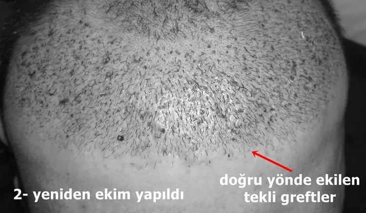 yanlış yapılan saç ekiminde saç yönlerini  düzeltme işlemi