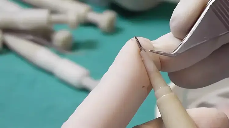 En el método DHI, la apertura del canal y el trasplante capilar se realizan simultáneamente.