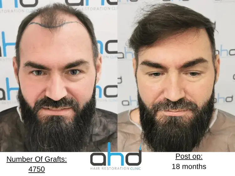 Un excelente resultado de trasplante capilar (antes y después) realizado utilizando el método DHI.