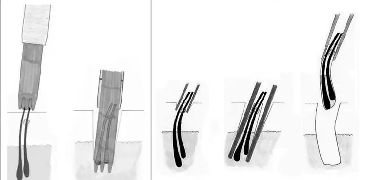 fue hair transplant method