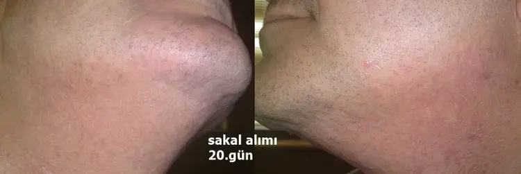 sakaldan saç ekimi sonrası 10.günde donör bölge