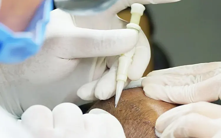 El uso de la técnica DHI aumenta la tasa de éxito de los trasplantes de cabello.