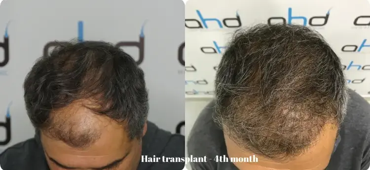 Greffe de cheveux de 4 mois