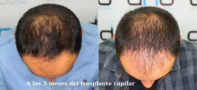 Imagen del trasplante capilar a los 3 meses