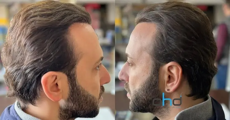 Apres-une-greffe-de-cheveux