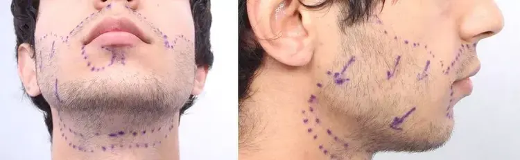Para un resultado natural en un trasplante de barba, las direcciones y los ángulos deben ser correctos.