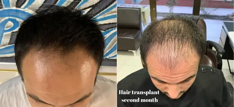 Greffe de cheveux de 2 mois