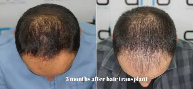 Greffe de cheveux 3 mois