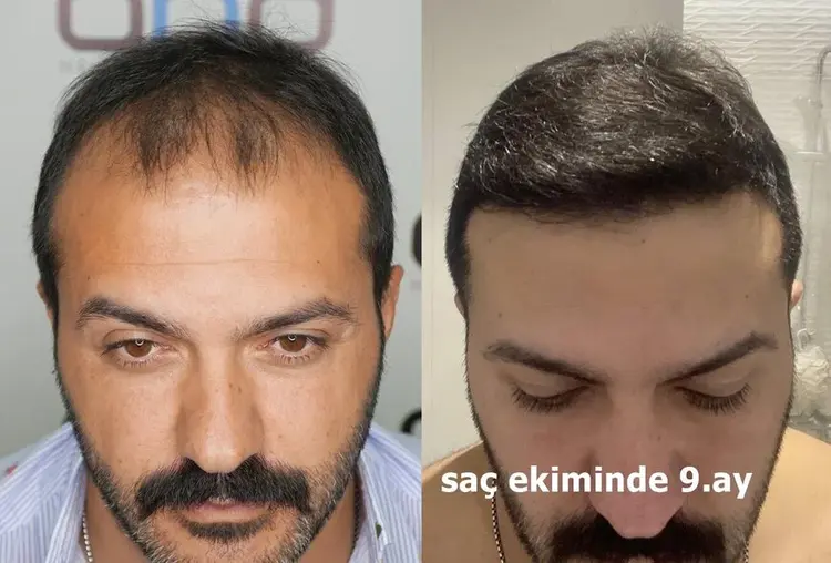 Greffe de cheveux de 9 mois