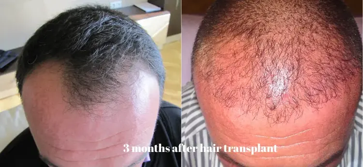 Greffe de cheveux 3 mois