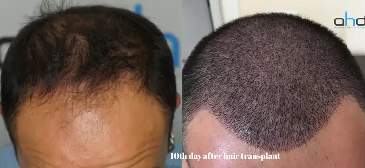 Image de la greffe de cheveux à 10 jours