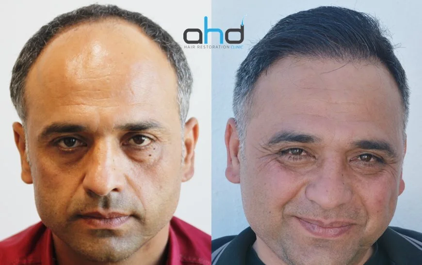 injerto capilar antes y despues
