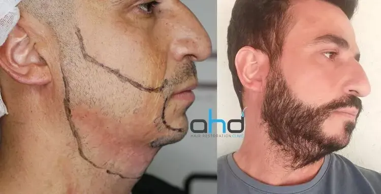 Após o transplante de barba, o homem com o rosto queimado está muito feliz.