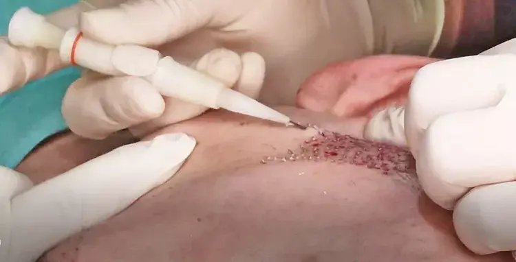 Os resultados mais otimizados em transplante capilar de barba são obtidos utilizando a técnica DHI.