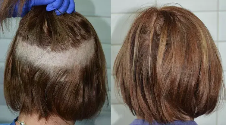 Perform hair transplantation on women using the shaveless method.