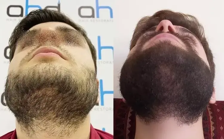 Resultados muito bons podem ser alcançados através do processo de densificação no transplante capilar de barba.