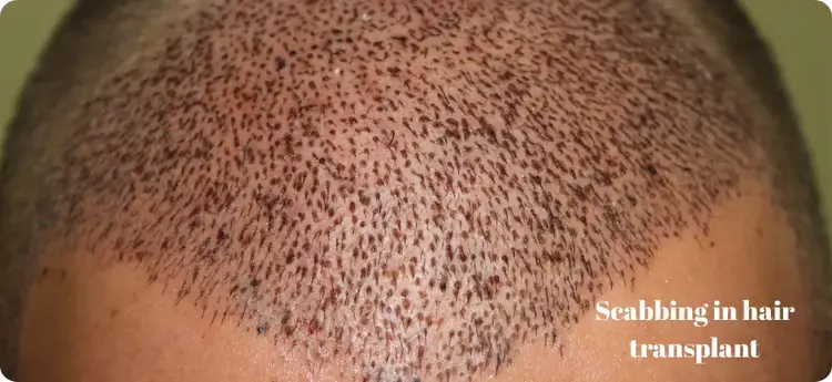 Les croûtes après une greffe de cheveux