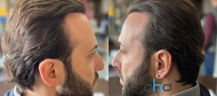 nach haartransplantation