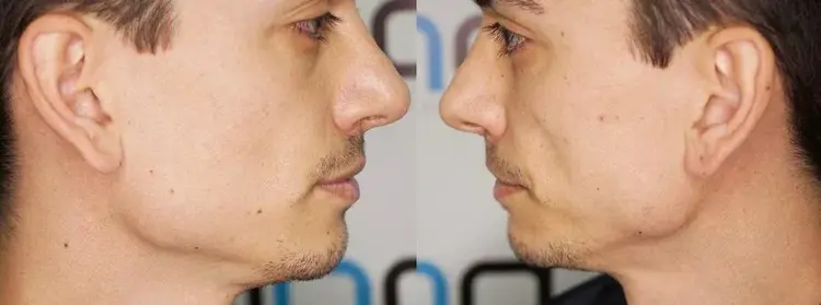 Um transplante capilar pode ser realizado em um homem que não tem barba nenhuma