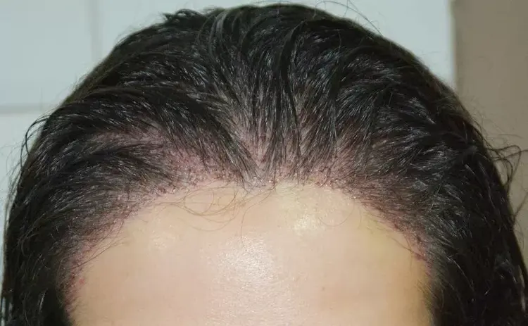 women hairline
