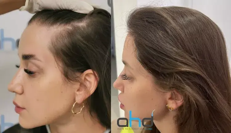 before and after hair transplant in women