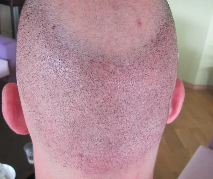 Zone donneuse 1er jour après la greffe de cheveux