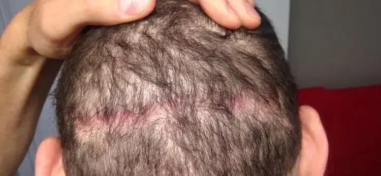Een foto van een donor die niet geschikt is voor haartransplantatie